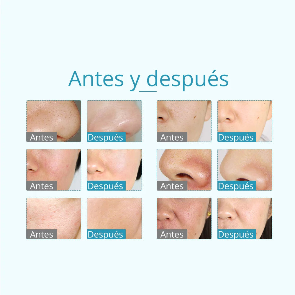 Facial Diamond Microdermabrasion Skin Firming Laser Eye Massage Beauty Equipment